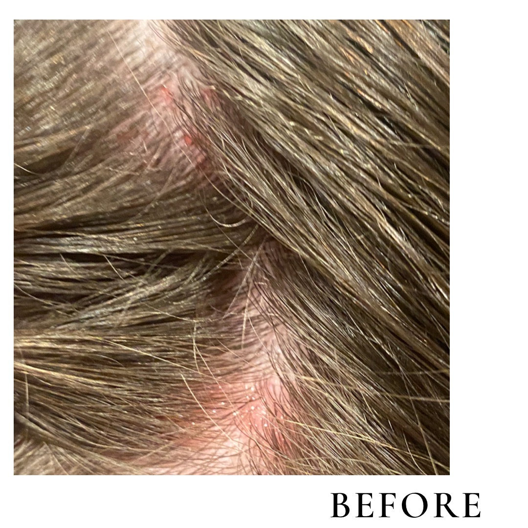 Scalp Repair Serum (Itchy Scalp + Hair Loss)